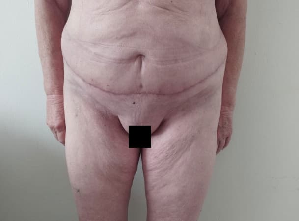 Мини-абдоминопластика, Липосакция - После (Анфас)