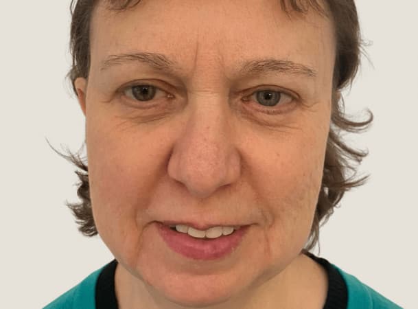 Эндоскопический лифтинг лба,  СМАС-лифтинг,  Липосакция подбородка и брылей, Платизмопластика - До (Анфас)