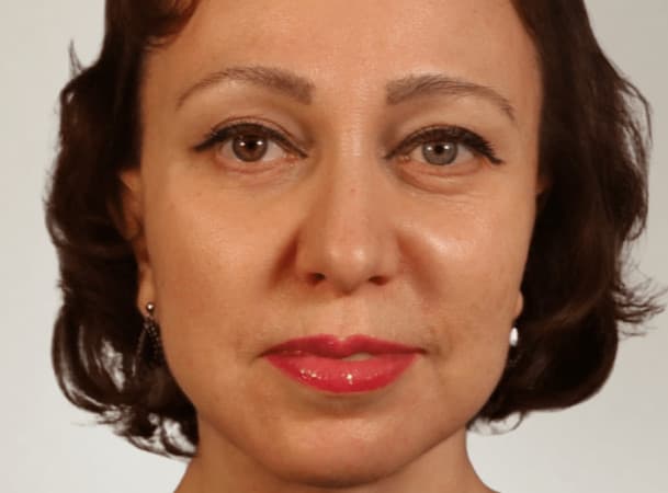 Эндоскопический лифтинг лба,  СМАС-лифтинг,  Липосакция подбородка и брылей, Платизмопластика - после