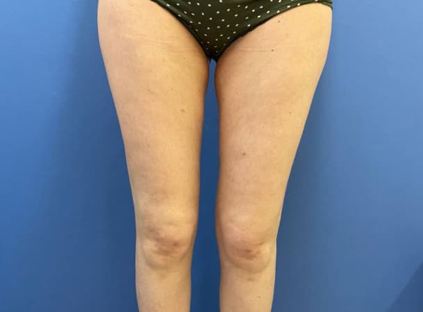 Липосакция коленей и внутренней стороны бедер - после
