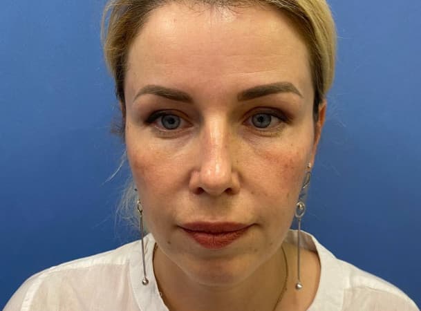 Эндоскопический лифтинг лба, СМАС -лифтинг - до