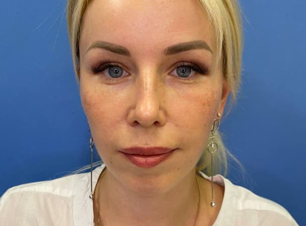 Эндоскопический лифтинг лба, СМАС -лифтинг - после