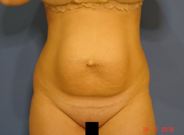 Абдоминопластика - до