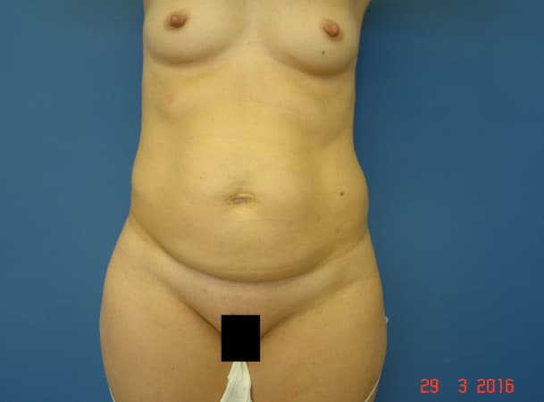 Абдоминопластика - до