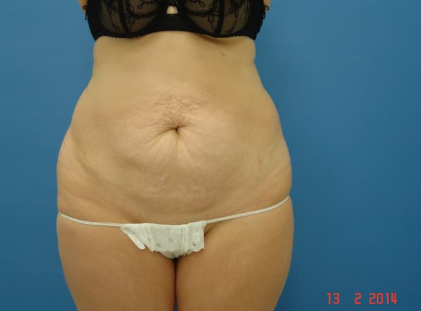 Абдоминопластика - до
