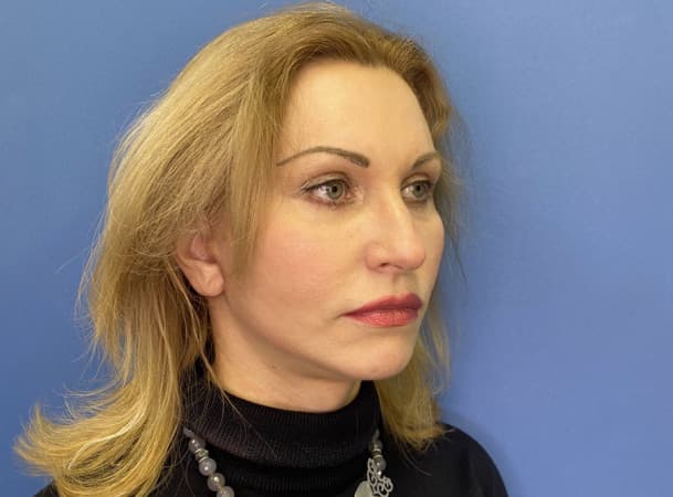 СМАС-лифтинг, Эндоскопический лифтинг лба - после