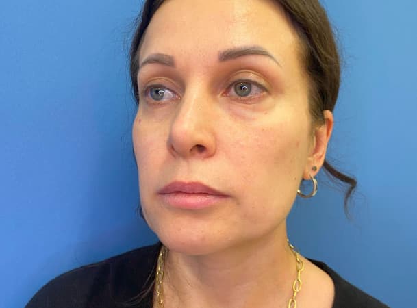 СМАС-лифтинг, Блефаропластика нижних век - До (Анфас)