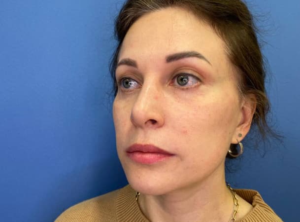СМАС-лифтинг, Блефаропластика нижних век - После (Анфас)