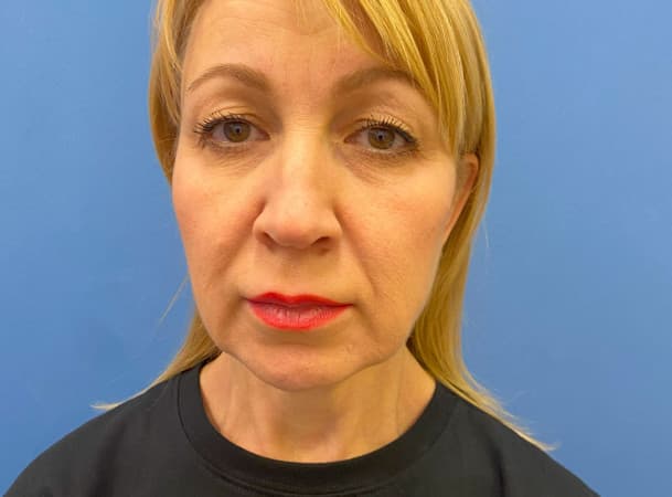 Эндоскопический лифтинг лба, Блефаропластика нижних век, Эндоскопическая подтяжка средней зоны, СМАС -лифтинг, Платизмопластика - До (Анфас)