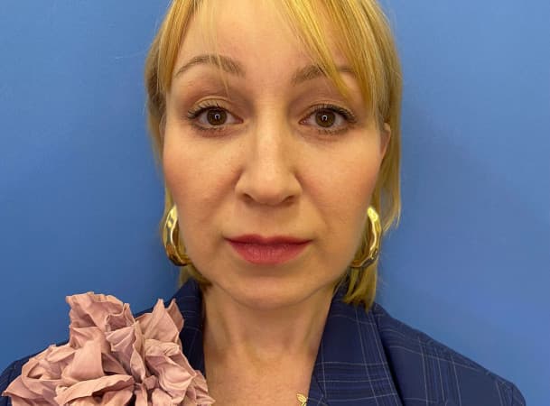 Эндоскопический лифтинг лба, Блефаропластика нижних век, Эндоскопическая подтяжка средней зоны, СМАС -лифтинг, Платизмопластика - После (Анфас)