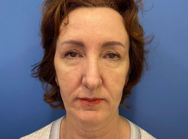 Эндоскопический лифтинг лба, Блефаропластика нижних век, СМАС-лифтинг, Платизмпластика - до