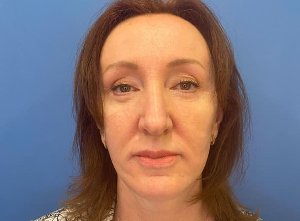 Эндоскопический лифтинг лба, Блефаропластика нижних век, СМАС-лифтинг, Платизмпластика - после