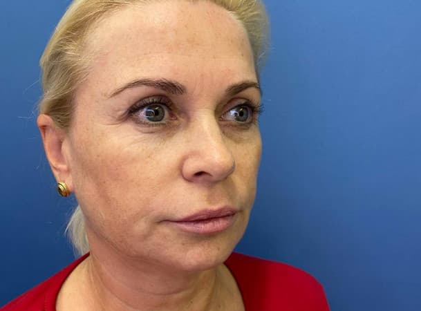 Эндоскопический лифтинга лба,  Блефаропластика нижних век, СМАС-лифтинг, Платизмопластика - до