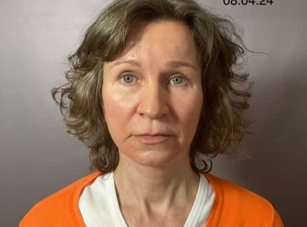 СМАС-лифтинг, Платизмопластика - до