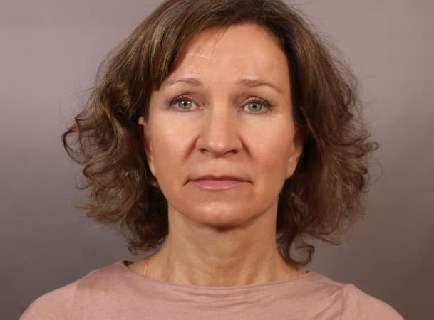 СМАС-лифтинг, Платизмопластика - после