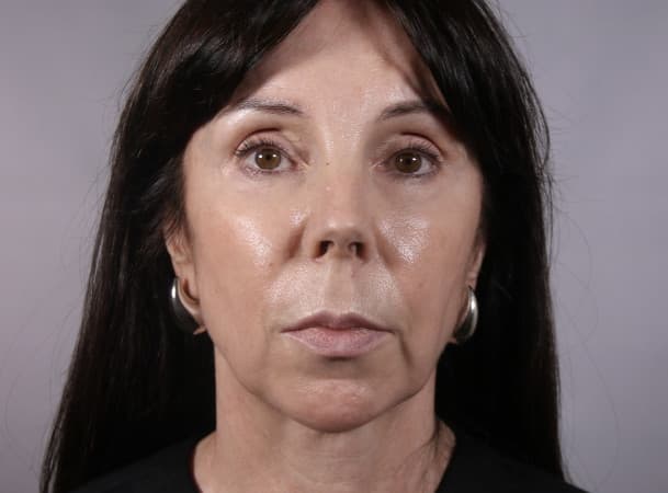 Лифтинг лба и овала лица - до