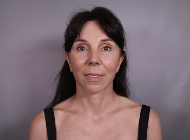 Лифтинг лба и овала лица - после