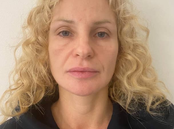 Тотальный лифтинг лица - до