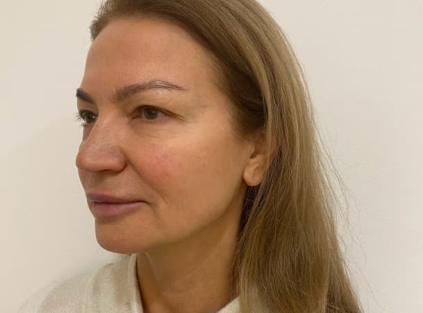 Подтяжка овала лица - до