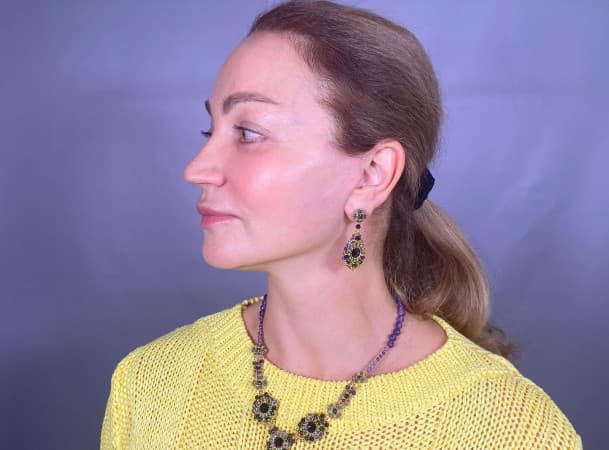 Подтяжка овала лица - после