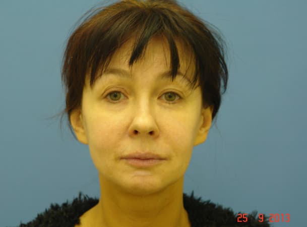 Тотальный лифтинг лица - до