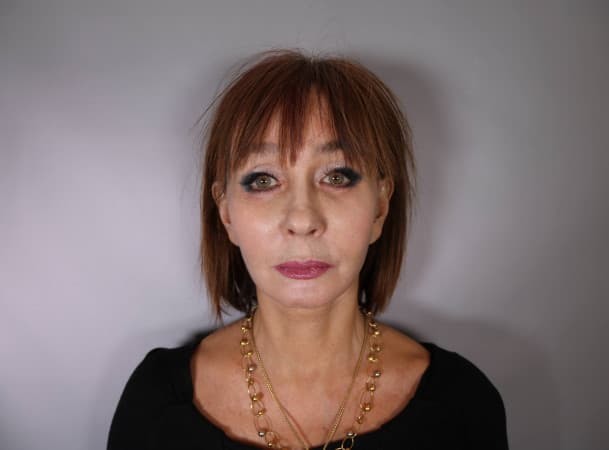 Тотальный лифтинг лица - после