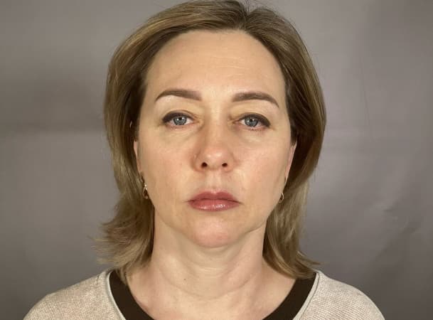Эндоскопический лифтинг лба, СМАС-лифтинг лица - до