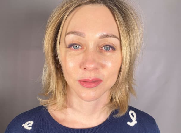 Эндоскопический лифтинг лба, СМАС-лифтинг лица - после