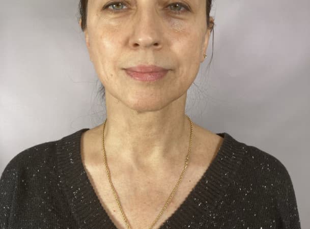 Пластика лица - до