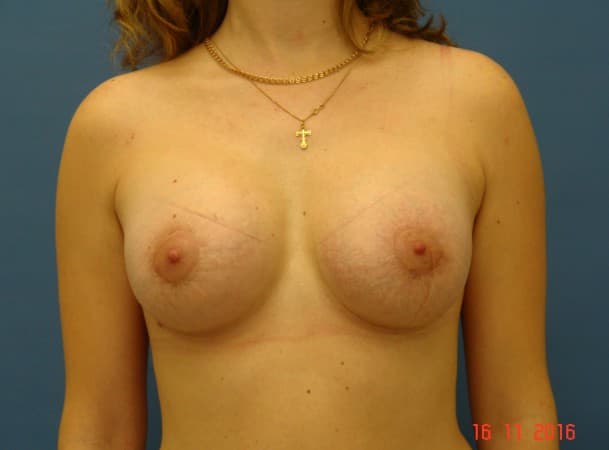Периареолярное увеличение груди - после