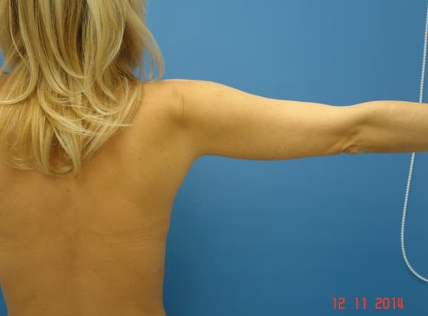 Лазерная липосакция  рук - до