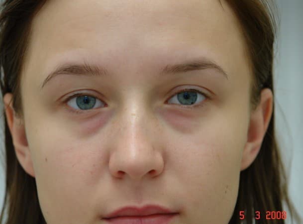 Трансконъюктивальная блефаропластика нижних век - До (Анфас)