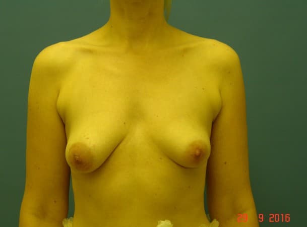 Подтяжка груди - до