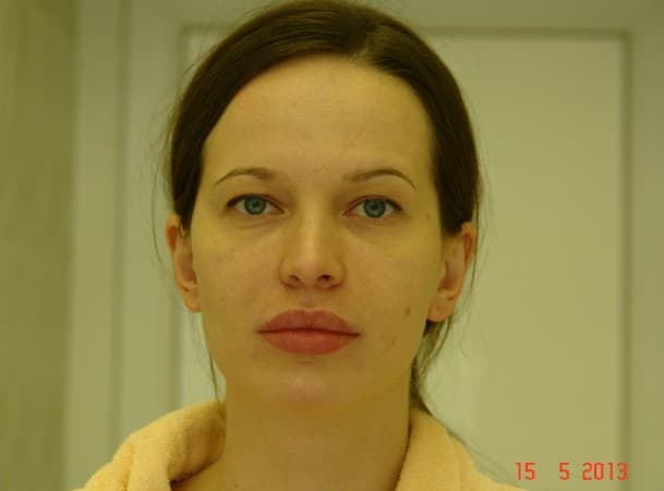 Эндоскопический лифтинг лба - До (Анфас)