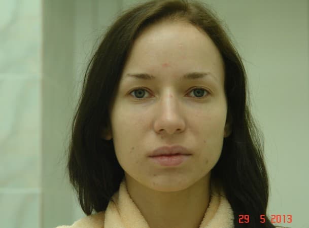 Эндоскопический лифтинг лба - до