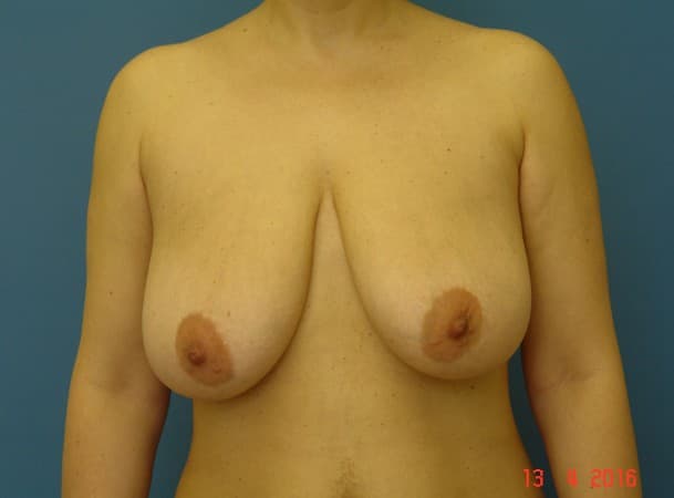 Уменьшение груди - до