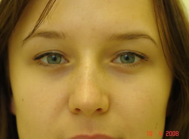 Трансконъюктивальная блефаропластика нижних век - После (Анфас)