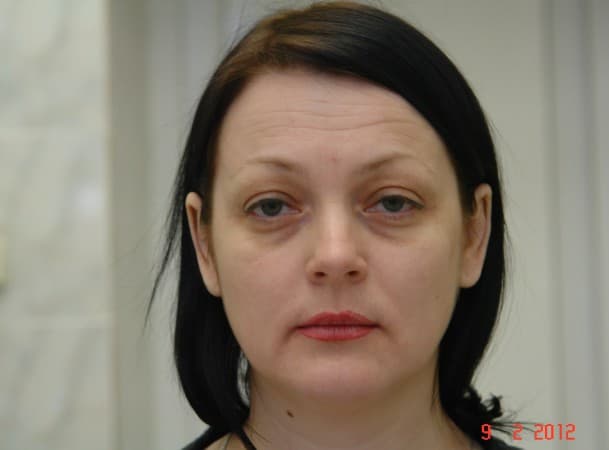 Эндоскопический лифтинг лба, средней зоны лица, блефаропластика - До (Анфас)