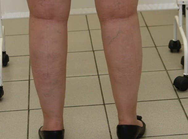 Лазерная липосакция ног, липосакция щиколоток - После (Сзади)