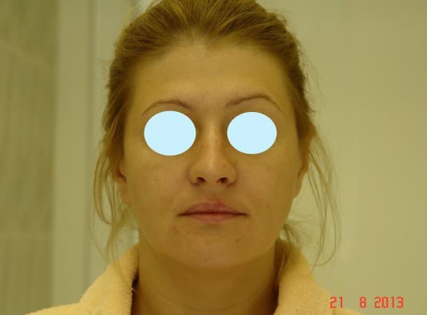 Эндоскопический лифтинг лица - до