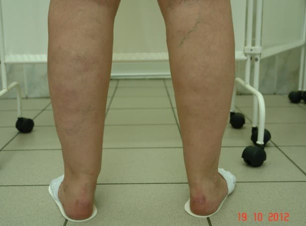 Лазерная липосакция ног, липосакция щиколоток - До (Сзади)