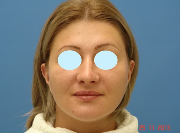 Эндоскопический лифтинг лица - после