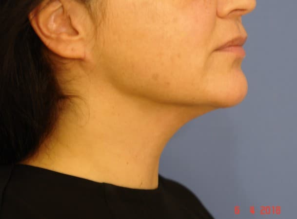 Липосакция подбородка - после