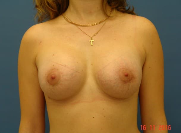 Периареолярное увеличение груди, имплантаты 375 и 325 мл - после