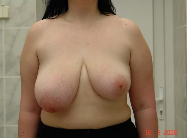 Уменьшение груди - до