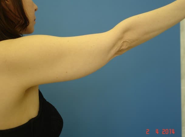 Липосакция рук - До (Сзади)