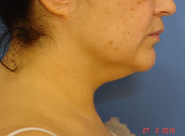 Липосакция подбородка - До (Анфас)