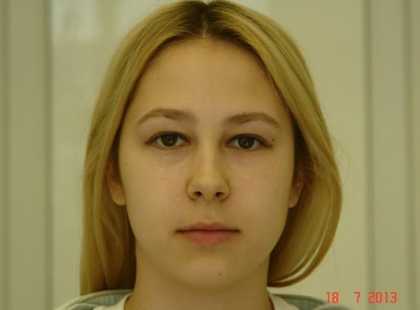 Эндоскопический лифтинг лба - до