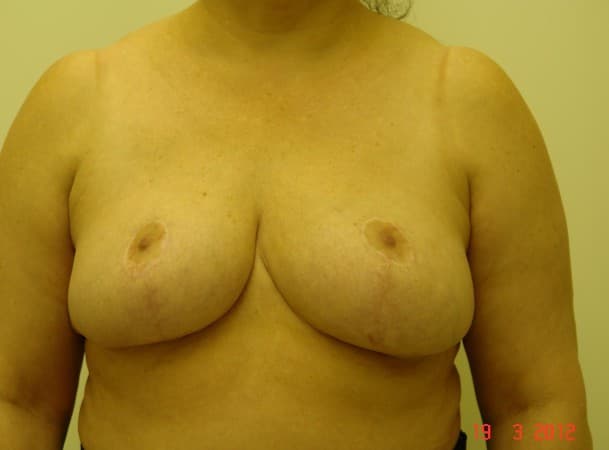 Уменьшение груди - после