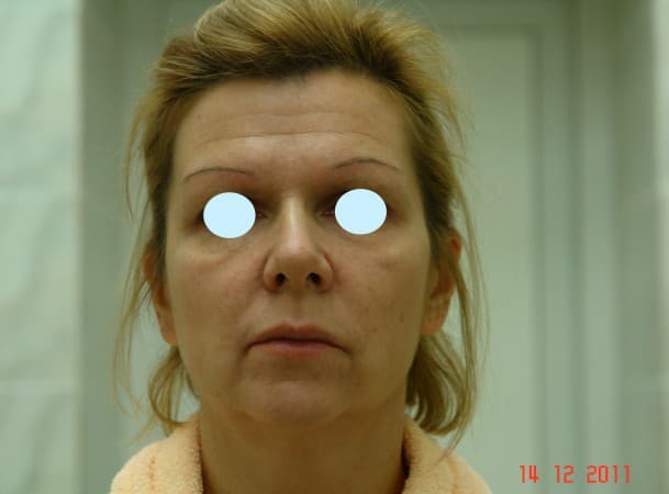 Тотальный эндоскопический лифтинг лица - До (Анфас)